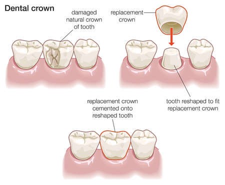 Dental Crown Diagram